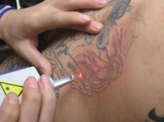 Laser tattoo removal treatment in progress