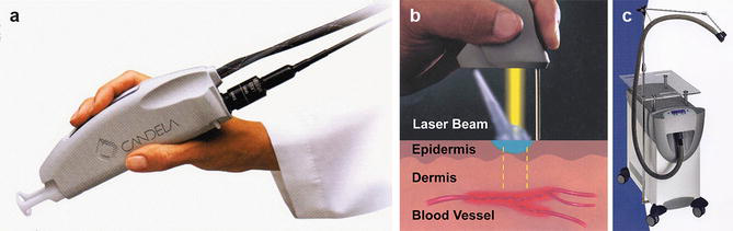 (a) Dynamic cooling device DCD coupled to a laser handpiece; (b) working diagram of the DCD, in which a cryogenic gas spray freezes the skin just before the laser pulse; (c) Cryo 6 standalone cool-air system for cooling skin during treatment
