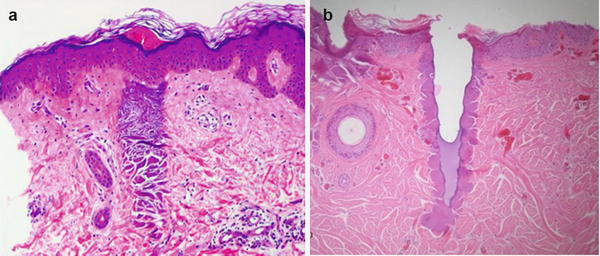 Skin histology: (a) non-ablative fractional Er:Glass laser showing only a coagulation column with intact skin surface; (b) fractional ablative CO2 laser showing tissue vaporization at the center of the column with coagulation around it