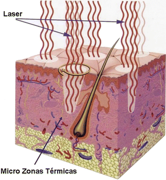 The science of fractional photothermolysis: microscopic treatment zones distributed among intact healthy skin