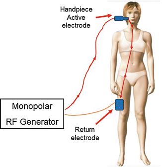 Basic configuration of a monopolar RF device: active handpiece electrode and large grounding-pad return electrode