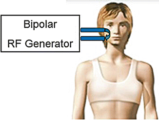 Schematic of a bipolar RF system with two adjacent electrodes at the treatment zone