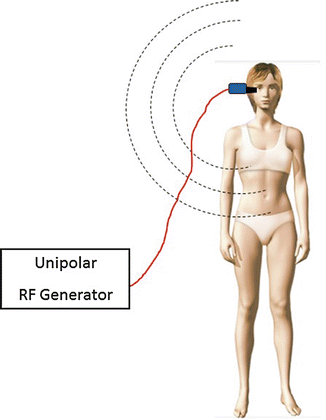 Schematic of a unipolar RF generator with a single coupling electrode