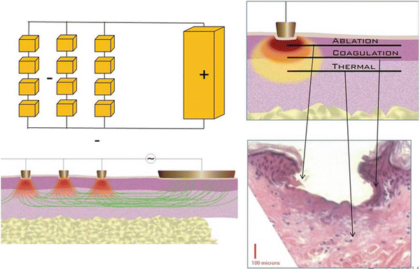 Impact of fractional RF energy in tissue, concentrated near the surface microelectrodes and spreading with depth