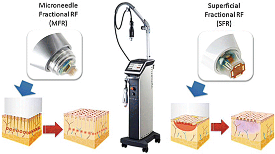 INFINI skin treatment platform with surface fractional RF and microneedle handpieces, by Lutronic