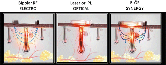 The ELOS effect: synergy of bipolar RF and light in a hair-removal treatment