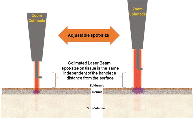 Collimated handpiece: spot size and fluence remain the same whether the handpiece touches the skin or is moved away; some handpieces offer a zoom adjustment of spot size