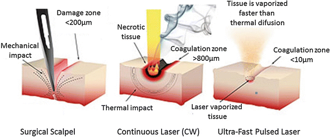 Comparison of tissue laser cutting in continuous wave mode and with ultrafast pulses; ultrafast pulses minimize thermal damage to adjacent tissue