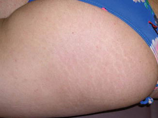 治療前の大腿部のストレッチマーク（striae distensae）。線状の色素脱失帯を認める
