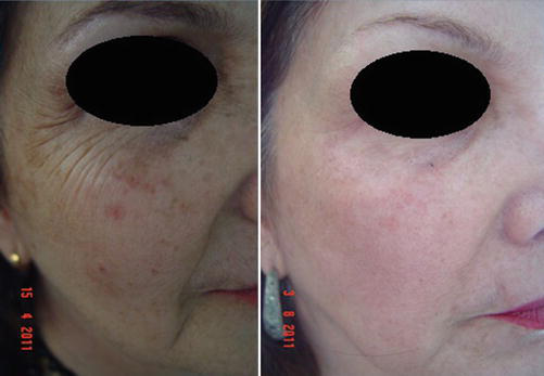 Klinische Vorher-Nachher-Aufnahmen mit Verbesserung lichtgealterter Haut nach dem CO2-Laser-Resurfacing