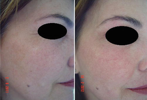 Klinische Vorher-Nachher-Aufnahmen der Haut vor und nach der CO2-Laser-Photorejuvenation