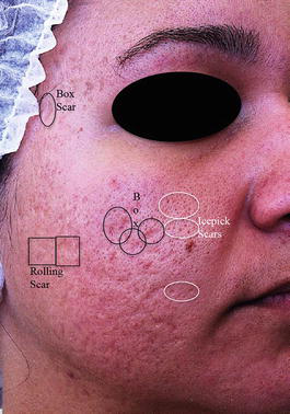 Diagram comparing the morphology of the three types of atrophic acne scars: narrow deep ice pick scars, wide shallow rolling scars and round boxcar scars