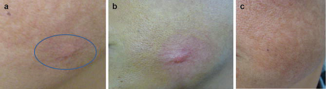 (a) Hypertrophic scar in the malar region before laser treatment; (b) the scar immediately after a CO2 laser session combined with topical triamcinolone drug delivery; (c) the scar two years after CO2 laser treatment with triamcinolone drug delivery