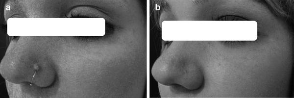 (a) Hypertrophic scar on the left nasal wing before the CO2 laser session; (b) the scar after a single CO2 session with triamcinolone 20 mg per mL applied as drug delivery