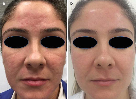 Atrophic acne scars before treatment and after two CO2 laser sessions performed with a three-month interval