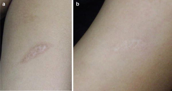 Postsurgical or post-traumatic scar before treatment and six months after four fractional CO2 laser sessions at 30 mJ and density 100
