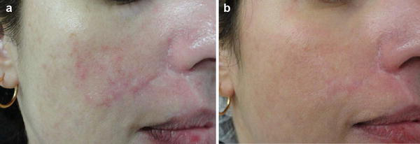 (a) Postsurgical scar before treatment; (b) the same scar after one fractional CO2 laser session