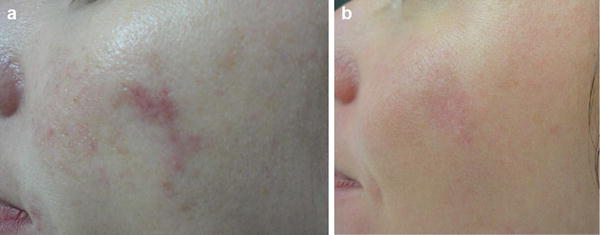 (a) Postsurgical scar before treatment; (b) the same scar after one fractional CO2 laser session