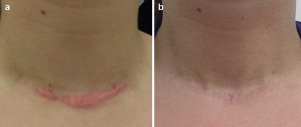 Postsurgical or post-traumatic scar before treatment and six months after four fractional CO2 laser sessions at 30 mJ and density 100