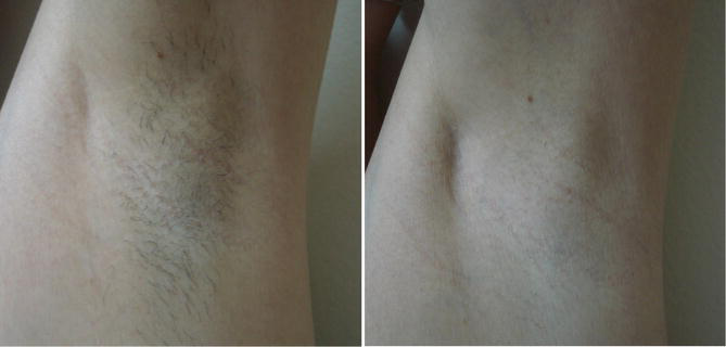 ダイオードレーザーを月1回、6回施行した腋窩の治療前後。治療後の像で体毛の顕著な減少がみられる