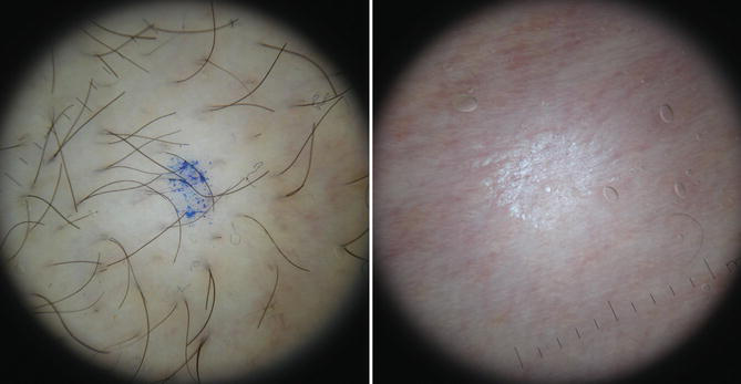 ダイオードレーザーを月1回、6回施行した腋窩の治療前後を示すダーモスコピー拡大画像。治療後に毛密度の低下がみられる
