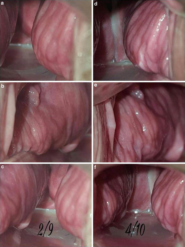 症例4のEr:YAG Femina治療前(a-c)と後(d-f)：右側、左側、両方の腟壁。セッション後に皺壁の増加と色調の改善がみられる