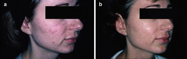 (a) Gesichtshaut mit geplatzten Äderchen und fleckiger Pigmentierung vor der IPL-Behandlung; (b) dasselbe Gesicht nach der Photorejuvenation mit intensiv gepulstem Licht mit gleichmäßigerem Hautton