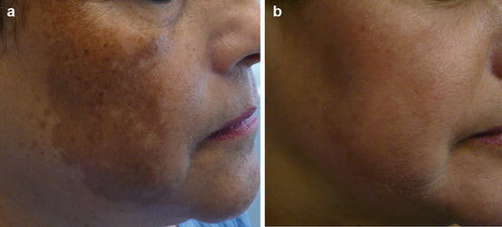 (a) Gesicht mit Melasma, das eine unregelmäßige Hyperpigmentierung vor der Behandlung zeigt; (b) dasselbe Gesicht nach der Melasma-Behandlung mit deutlicher Aufhellung der Pigmentierung