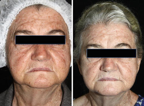 Пациент с фотоповрежденной кожей и множественным актиническим кератозом до и после одного сеанса дневной ФДТ с метиламинолевулинатом: отмечается уменьшение количества очагов, улучшение текстуры и пигментации кожи