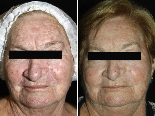 Другой пациент с фотоповрежденной кожей и актиническим кератозом до и после одного сеанса дневной ФДТ с метиламинолевулинатом: отмечается исчезновение очагов и улучшение внешнего вида кожи