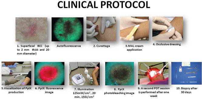 ブラジル多施設プログラムで使用される簡略MAL-PDT臨床プロトコルのフローチャート。病変の前処置、クリームのインキュベーションから、蛍光ガイド下照射、経過観察評価まで