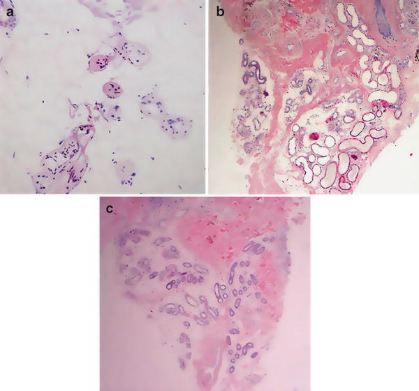 Histologische Biopsiepräparate vor und nach der FMR-Behandlung: hitzebedingte Koagulation von Drüsen und Dermis unmittelbar nach der Behandlung, Hautprobe zu Studienbeginn sowie reduzierte Anzahl und Größe der apokrinen und ekkrinen Drüsen nach der Behandlung