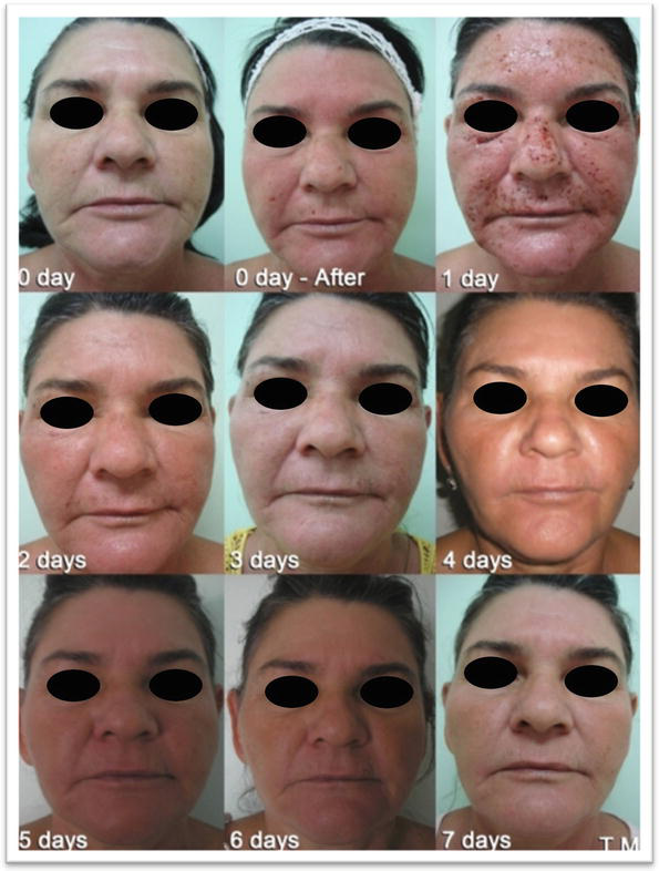 Tägliche Sequenz der ablativen Heilungsergebnisse der Haut nach einer Behandlung mit fraktionierter Mikroplasma-Radiofrequenz