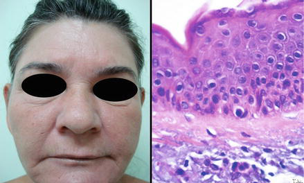 Lichtmikroskopische Aufnahme fünfzehn Tage nach der Behandlung: Ein dünnes Band aus Kollagengewebe trennt die Epidermis von der elastotischen Dermis (H&E, ursprüngliche Vergrößerung ×100)