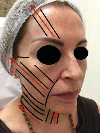 微細集束超音波治療のために顔面および頸部の右側に描かれた斜めのマーキング線