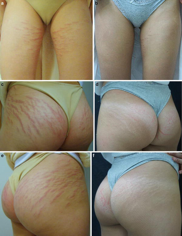 無菌ビタミンCを用いたDermapen経表皮薬物送達2回セッションと、それに先立つCaHA注射2回の前後。内もも(a,b)、左臀部(c,d)、右臀部(e,f)