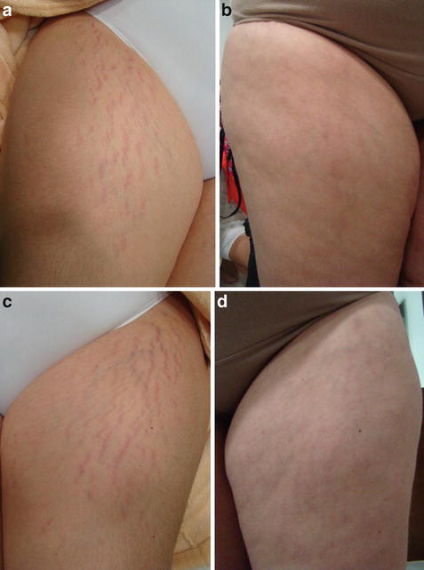 無菌ビタミンCを用いたDermapen経表皮薬物送達2回セッションと、それに先立つCaHA注射1回の前後。右もも(a,b)、左もも(c,d)