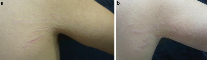 無菌ビタミンCを用いたDermapen経表皮薬物送達2回セッションの前(a)と後(b)。TDD前にCaHA注射も1回実施